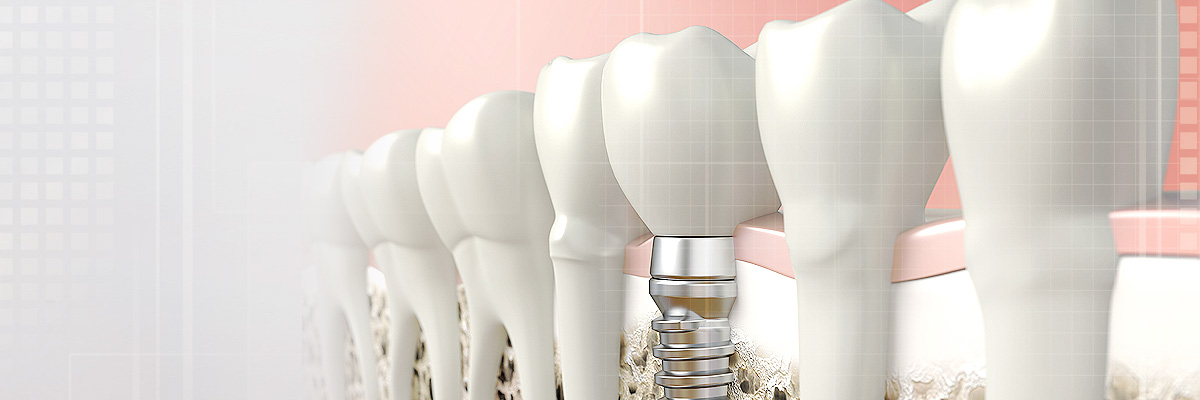 dental-implants-header